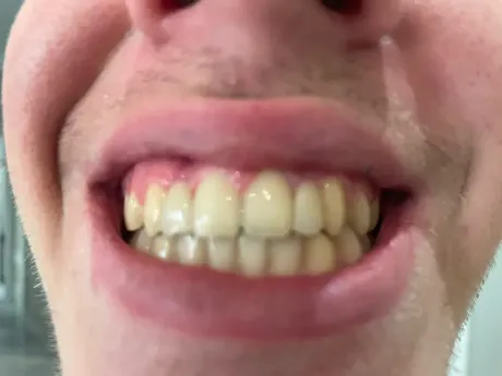 Primer plano de la boca de una persona con dientes visibles, ligeramente amarillos y labios cerrados.