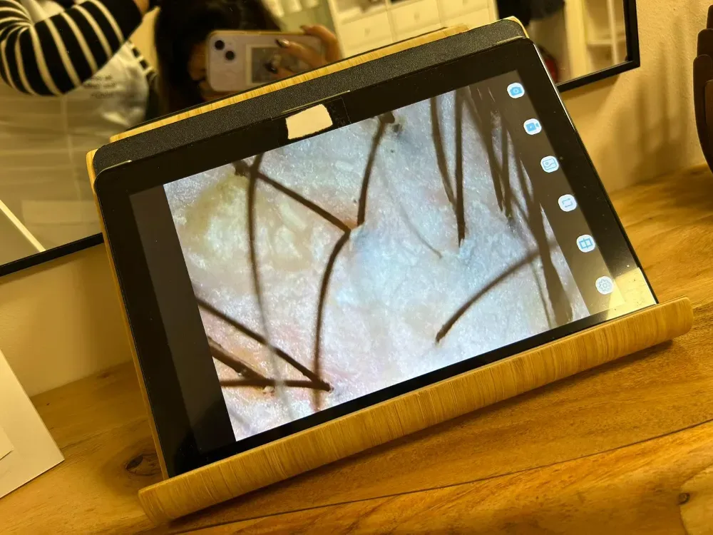 Una tableta sobre un soporte de madera muestra una vista microscópica en primer plano del cuero cabelludo humano.