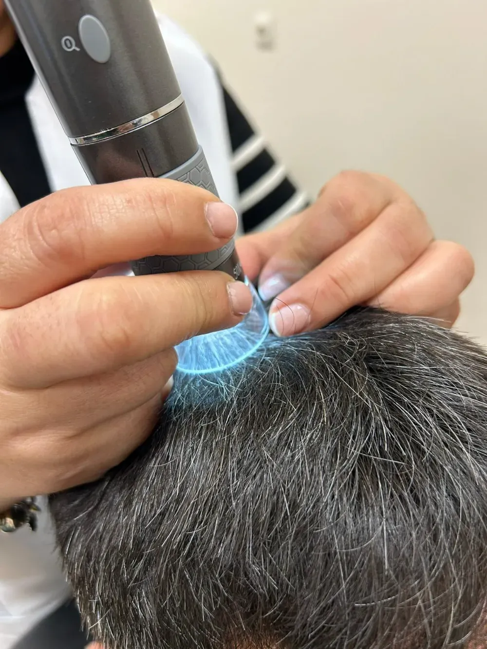 Para realizar un examen dermatológico, se coloca un analizador digital del cuero cabelludo con una lupa de luz azul.