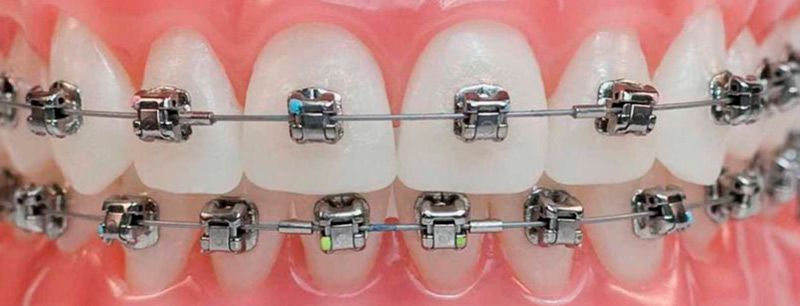 Un primer plano de los dientes de una persona con aparatos ortopédicos.