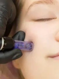 Primer plano de una persona sometida a un tratamiento de microagujas en la mejilla, una mano en un guante negro sostiene el dispositivo.