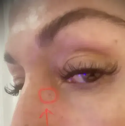 Primer plano del ojo y la nariz de una persona con una pequeña mancha oscura. El círculo rojo y la flecha señalan la mancha.