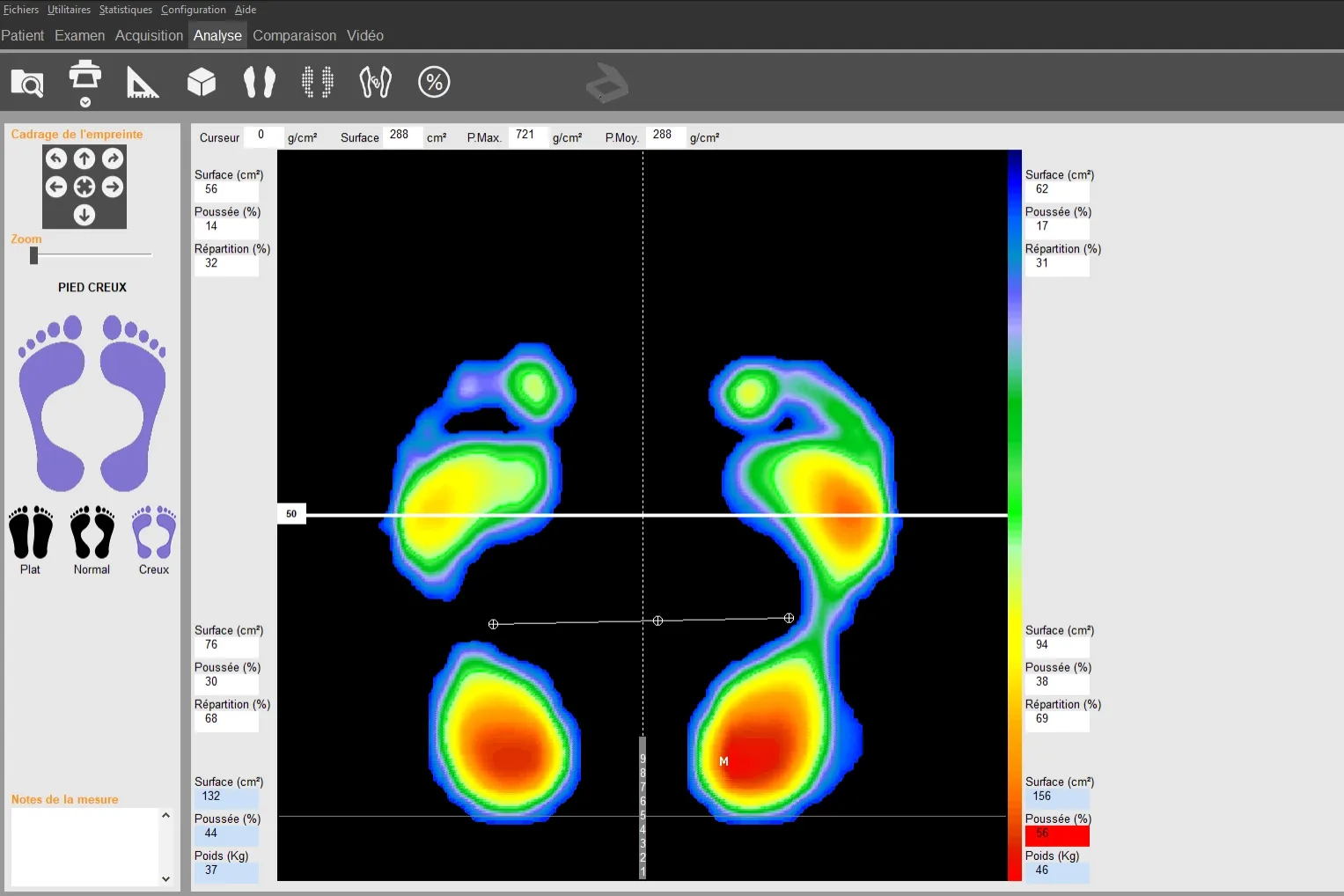 Un examen de voûte plantaire