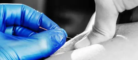 motus physio ag – Rückenbehandlung mit Dry Needling