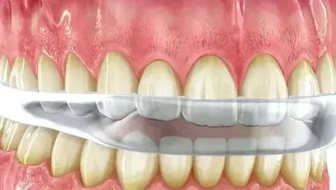 Un primer plano de los dientes de una persona con un protector bucal.
