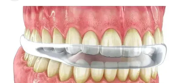 Un primer plano de los dientes de una persona con un protector bucal.