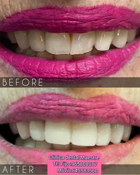 Una foto de antes y después de los dientes de una mujer con lápiz labial rosa.