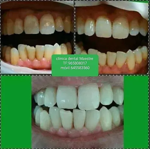 Un collage de fotos de los dientes de una persona con un recuadro verde que dice clínica dental massalia