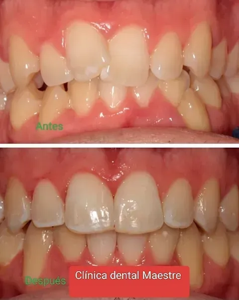 Fotografía de antes y después de los dientes de una persona tomada por la Clínica Dental Maestre.