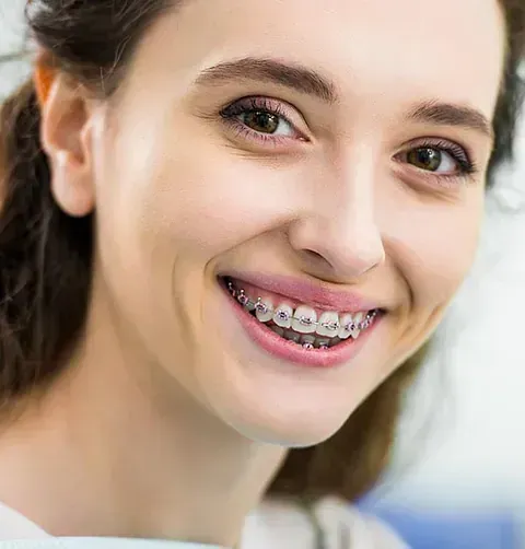 Un primer plano de una mujer con aparatos dentales sonriendo.