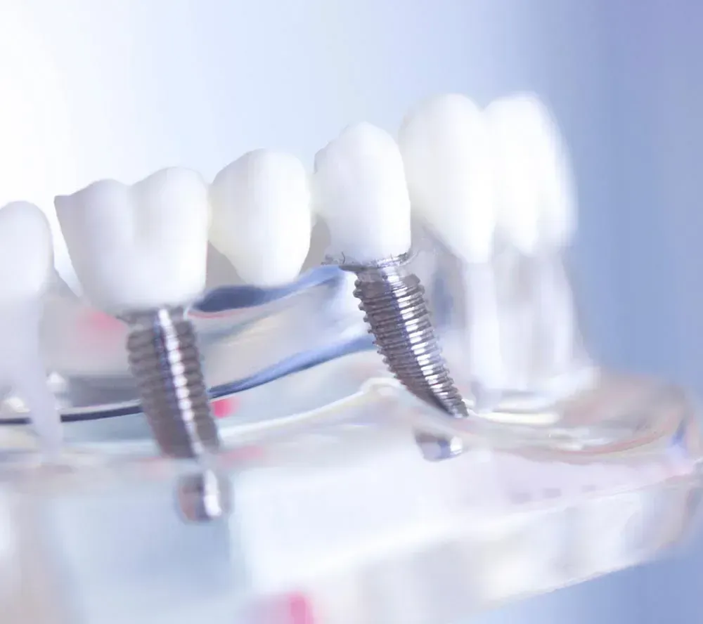 Un primer plano de un modelo de dientes con implantes dentales.
