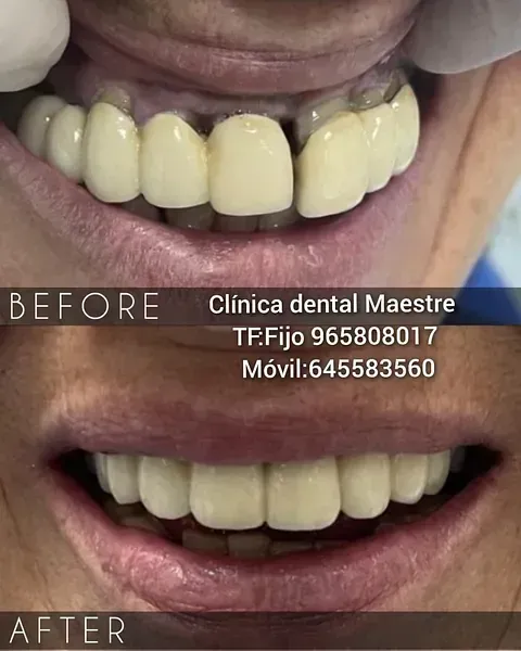 Una fotografía de antes y después de los dientes de una persona.