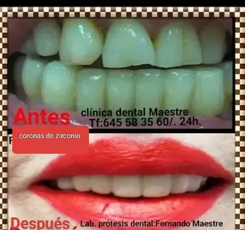 Una fotografía de antes y después de los dientes y los labios rojos de una persona.