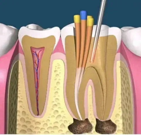 Un primer plano de un diente con una aguja saliendo de él.