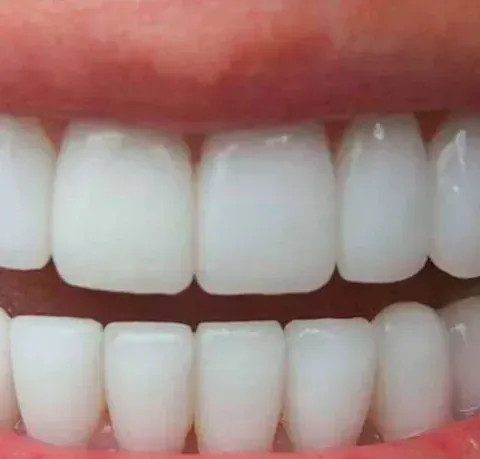 Un primer plano de los dientes de una persona con dientes blancos.
