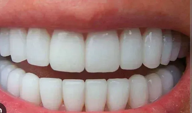 Un primer plano de los dientes de una persona con dientes blancos.