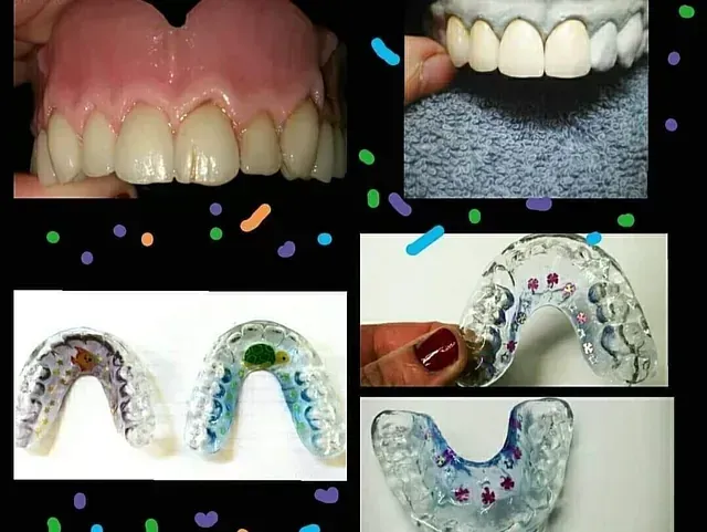 Un collage de cuatro imágenes de dientes y protectores bucales.