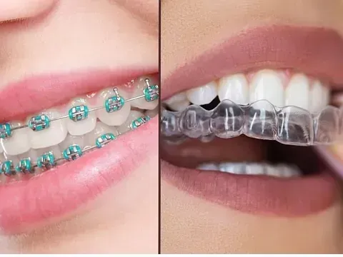 Un primer plano de los dientes de una persona con aparatos ortopédicos y una bandeja Invisalign.