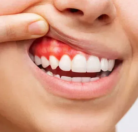 Un primer plano de la boca de una mujer con una mancha roja en los dientes.