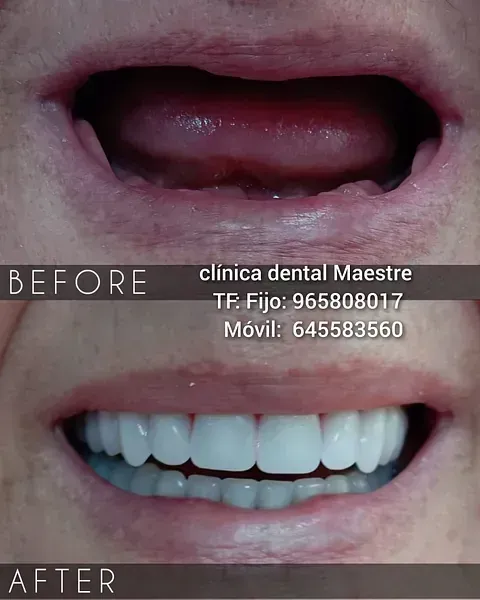 Una foto de antes y después de los dientes de una persona.