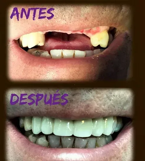Una fotografía de antes y después de los dientes de una persona.