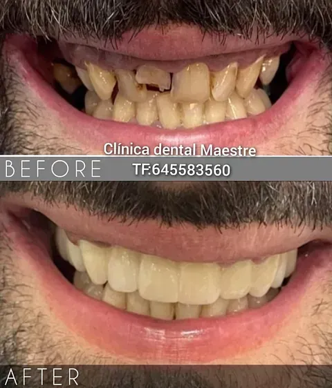 Una fotografía de antes y después de los dientes de un hombre.