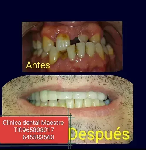 Una imagen de la boca de un hombre antes y después del trabajo dental.