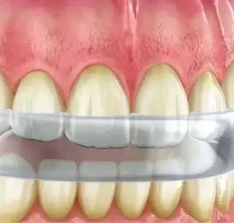 Un primer plano de los dientes de una persona con un protector bucal puesto.
