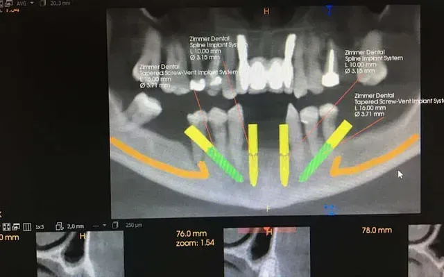Se muestra una radiografía de los dientes de una persona en la pantalla de una computadora.