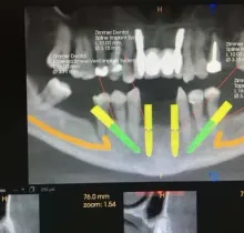 Una pantalla de computadora muestra una radiografía dental de los dientes de una persona.
