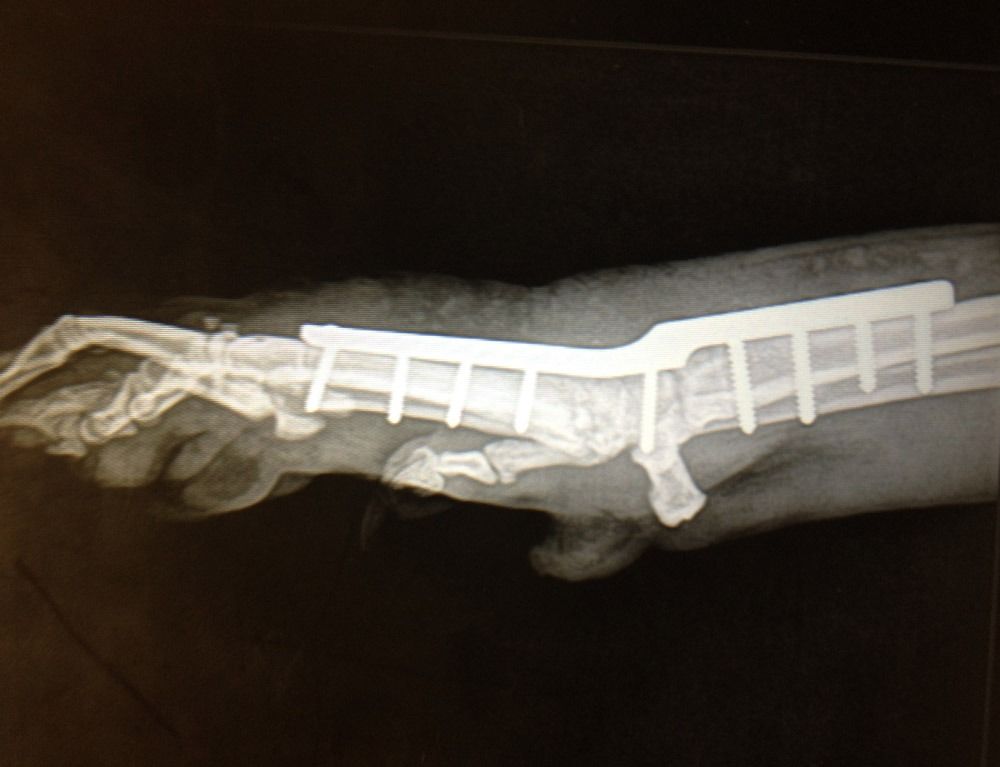 Una radiografía en blanco y negro del brazo de una persona con un aparato ortopédico.