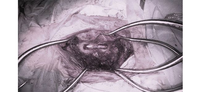 Una fotografía en blanco y negro de una persona siendo operada.