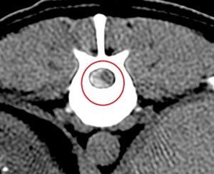Una imagen en blanco y negro de la columna vertebral de una persona con un círculo rojo alrededor de ella.