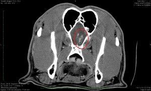 Una tomografía computarizada de la cabeza y el cuello de una persona con un círculo rojo en el medio.