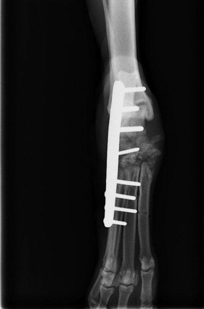 Una radiografía del tobillo de una persona con un tornillo en él.