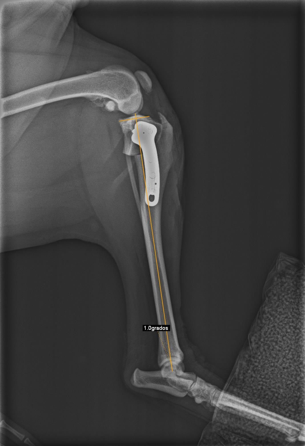 Una radiografía del brazo de una persona con un tornillo en él.