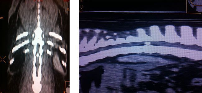 Una tomografía computarizada de la columna vertebral de una persona y una resonancia magnética de la columna vertebral de una persona.