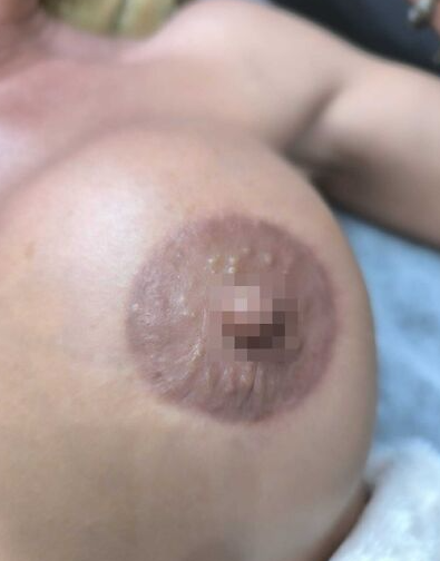 Primer plano del pecho de una persona con una marca circular oscura alrededor del pezón.