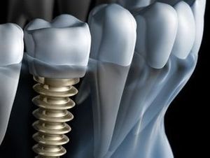 Dr. Nicolas Bittar - Médecin-dentiste - Montreux - prothèses dentaires - chirurgie