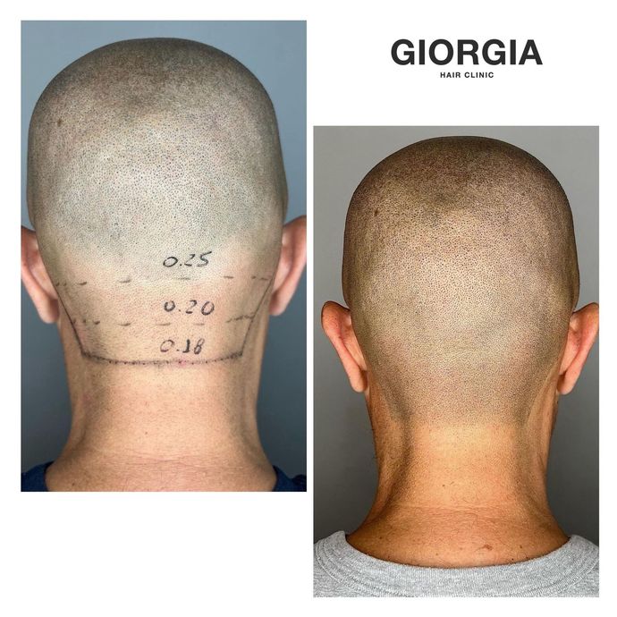 Antes y después de un tratamiento de micropigmentación capilar en la nuca de un hombre. La zona tratada luce más rellena.