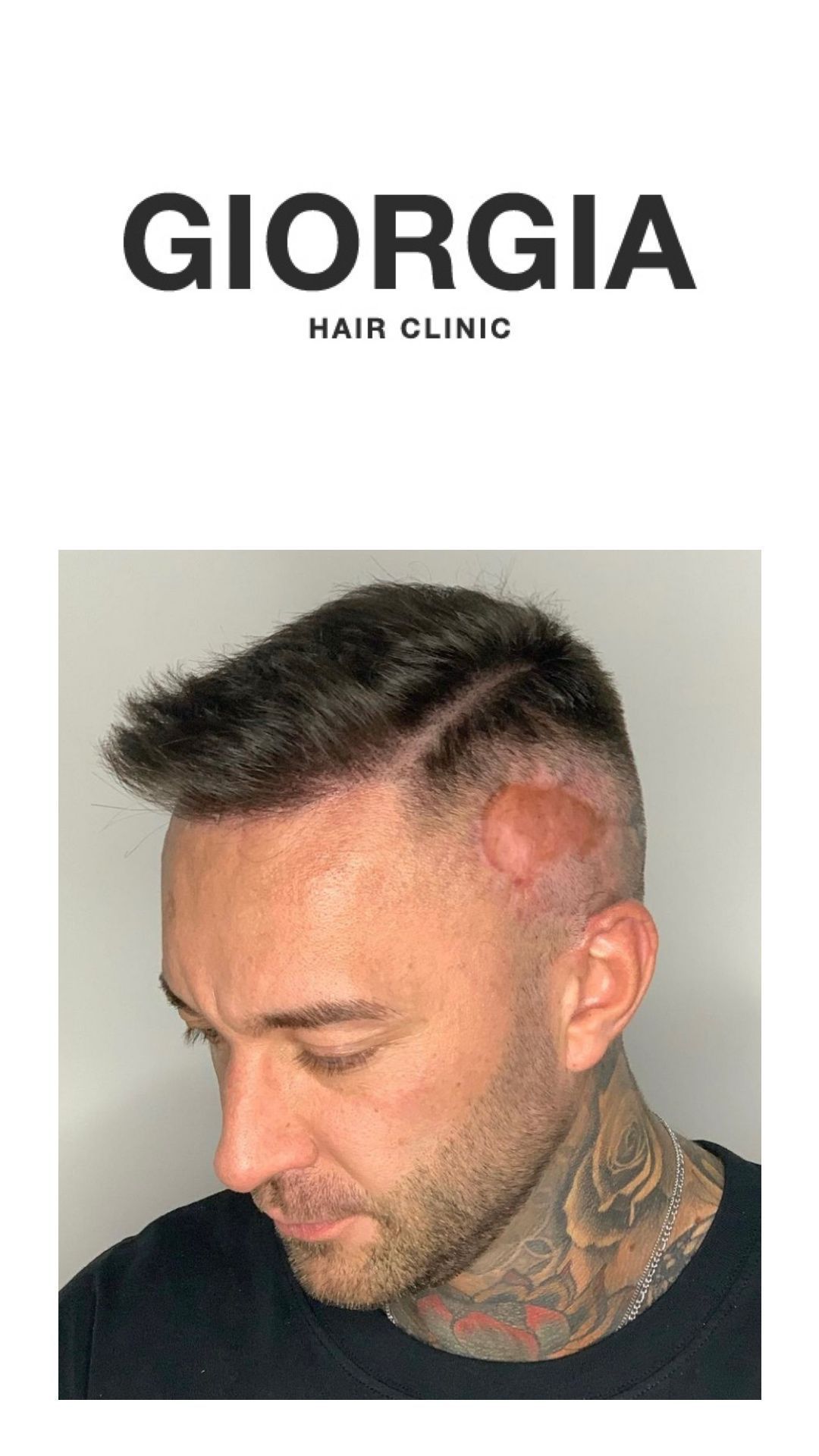 Hombre con cabello corto y oscuro muestra un procedimiento de trasplante capilar
