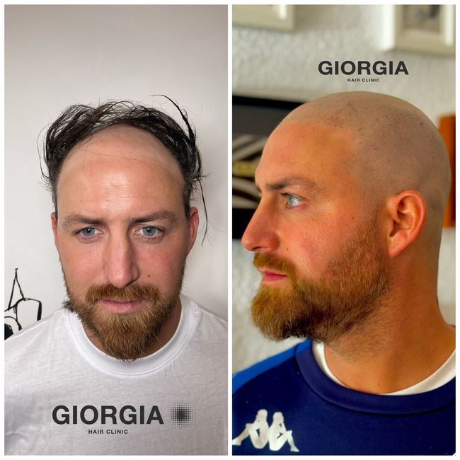 Un hombre antes y después de un trasplante capilar. A la izquierda, tiene el cabello mal; a la derecha, la cabeza rapada. 