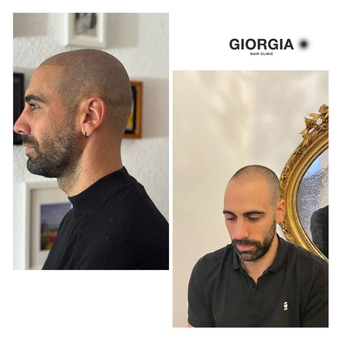 Hombre con la cabeza rapada antes y después de un tratamiento de micropigmentación capilar. Lleva una camiseta negra 