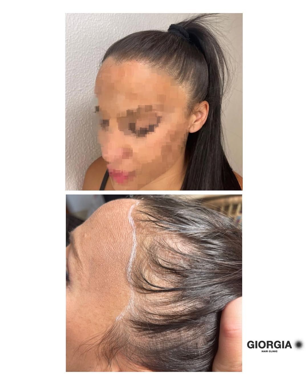 Mujer antes y después del tratamiento de la línea capilar. 
