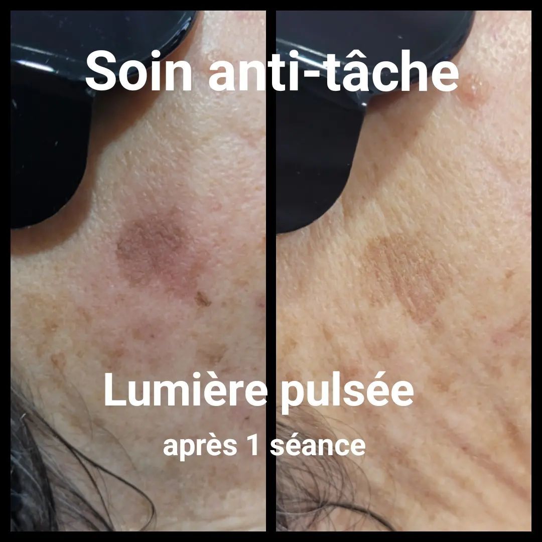 Gros plan sur une joue qui présente une tache brune avant et après le traitement Ariane