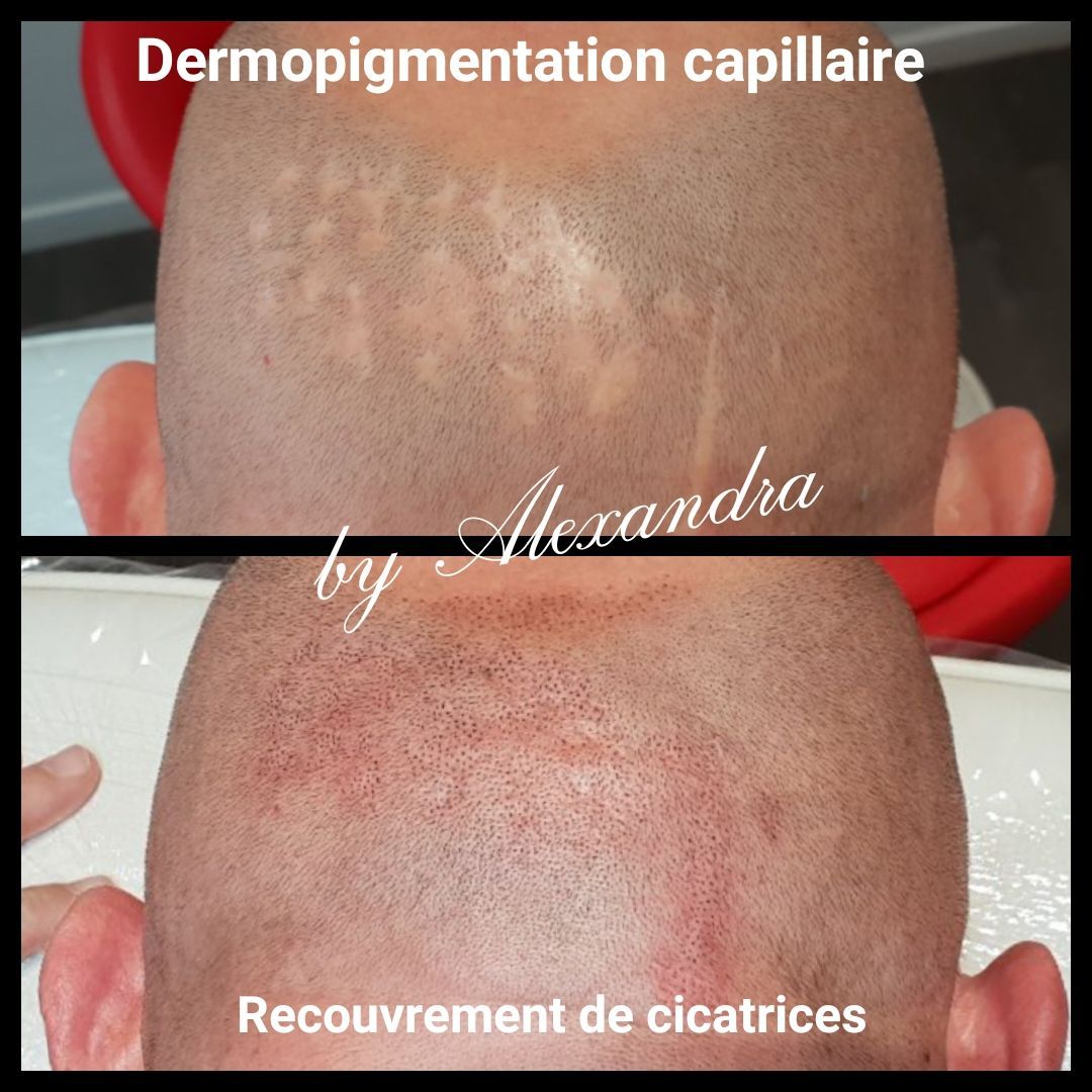 SMP homme de profil avant/après, cicatrice à camoufler