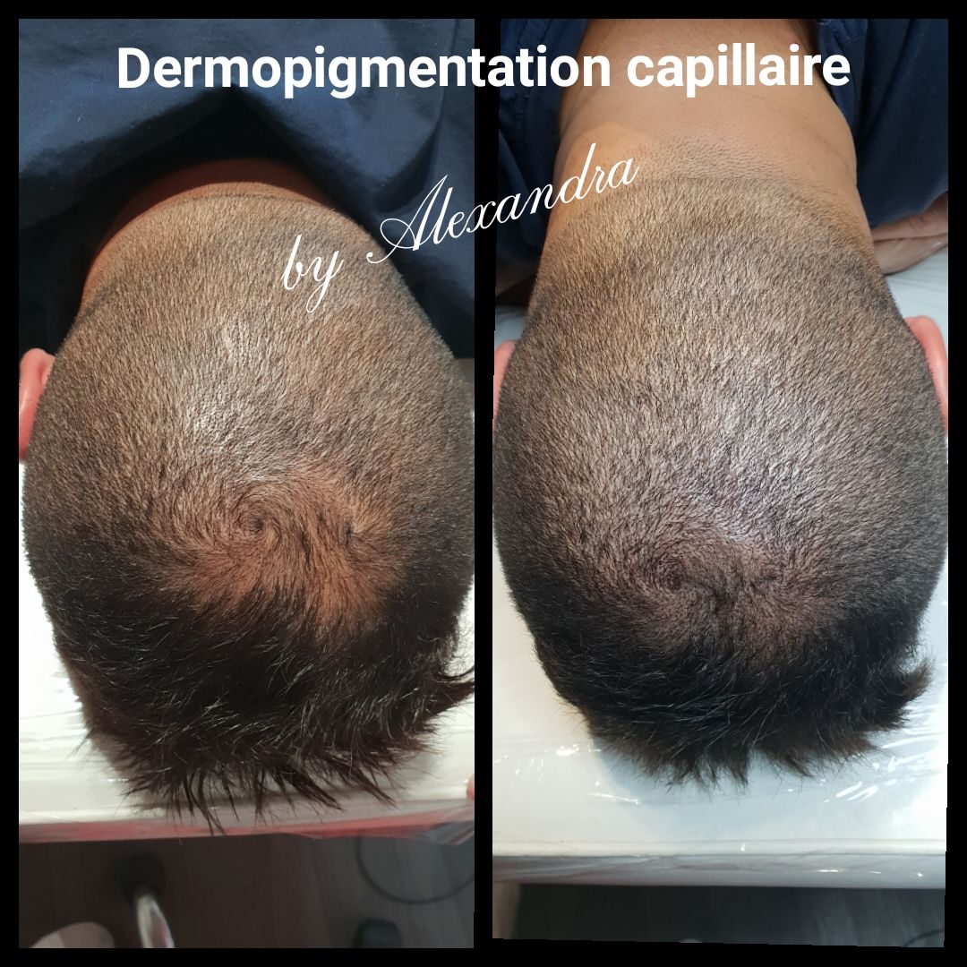 SMP homme de profil avant/après, crâne arrière