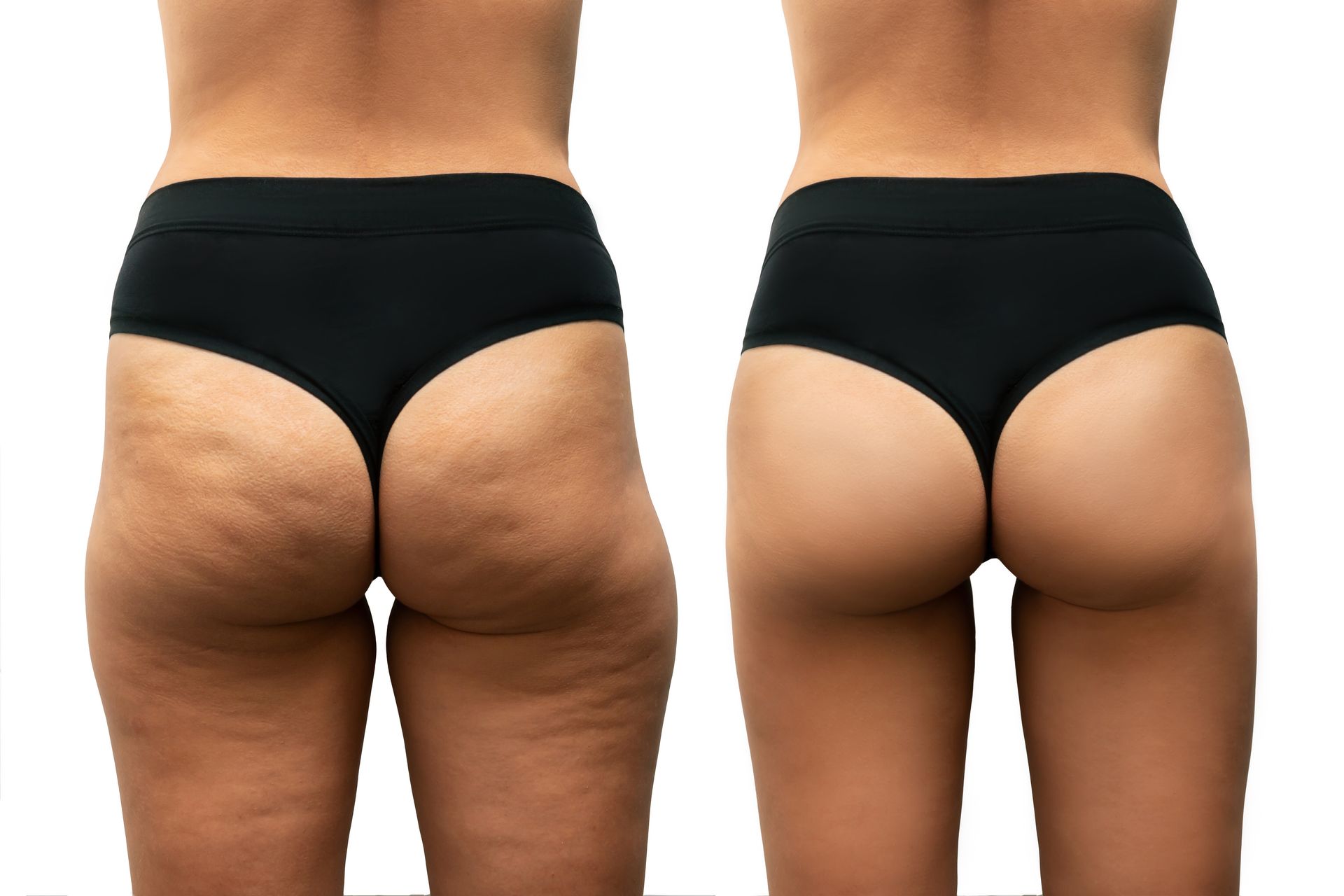 Palper rouler cellulite avant/après