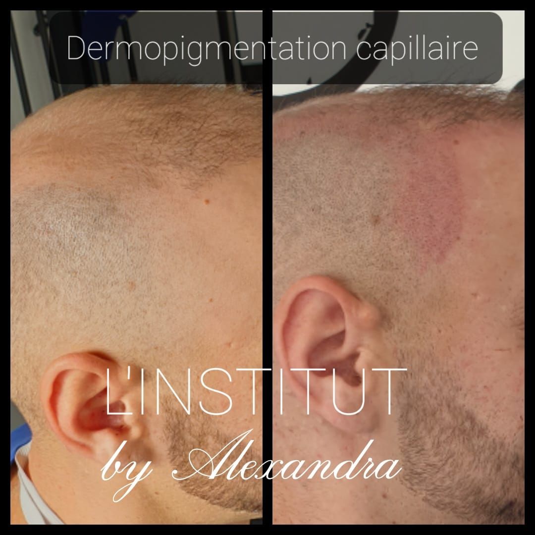 SMP homme de profil avant/après