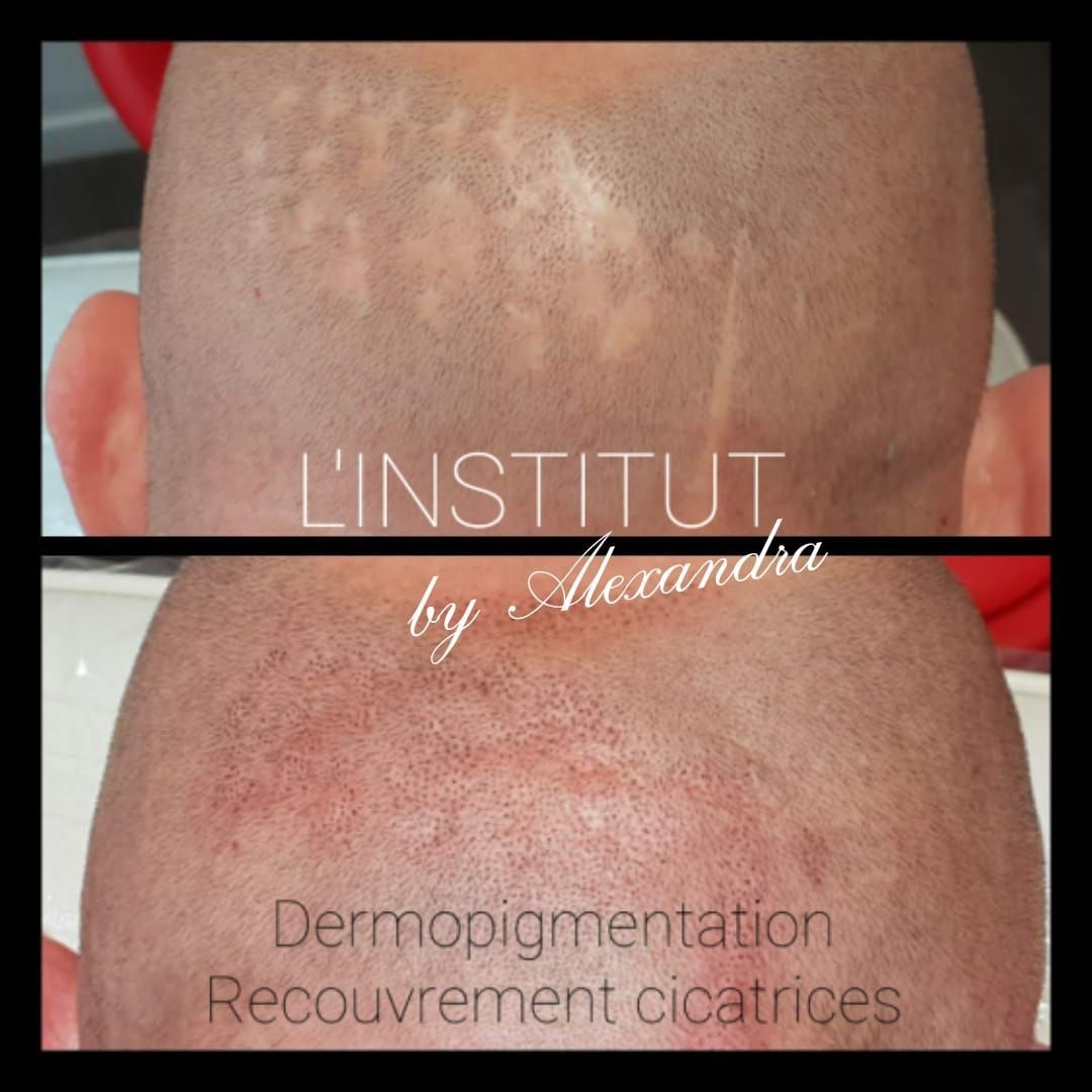 SMP homme avant/après, vue arrière du crâne